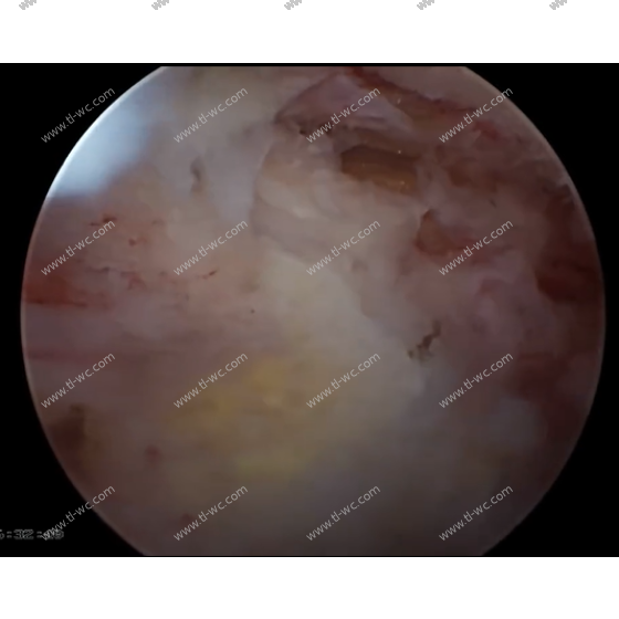 UBE Thoracic Floodwood Technique for Thoracic Ossification of Ligamentum Flavum (OLF)