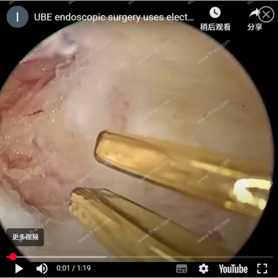The use of bipolar electrocoagulation forceps in UBE endoscopic surgery